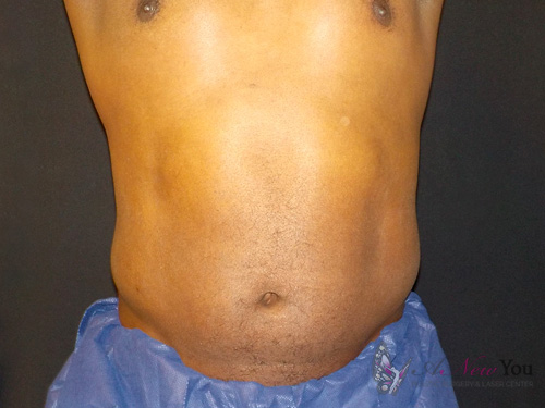 CoolSculpting® After CoolSculpting® After - Chicago, IL