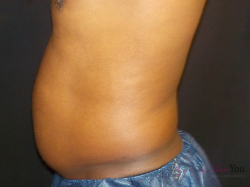 CoolSculpting® Before - Chicago, IL