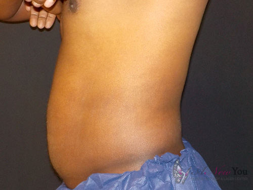 CoolSculpting® After CoolSculpting® After - Chicago, IL