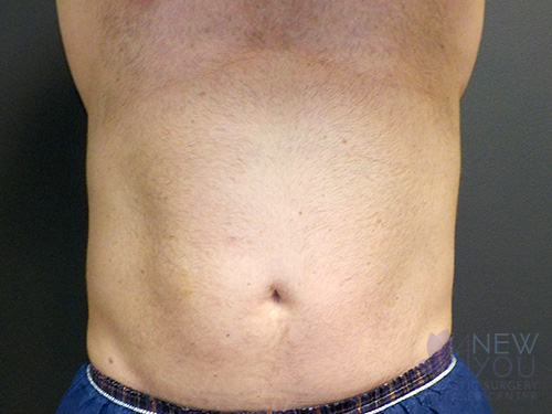 CoolSculpting® Before - Chicago, IL