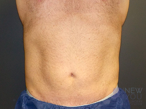 CoolSculpting® After - Chicago, IL