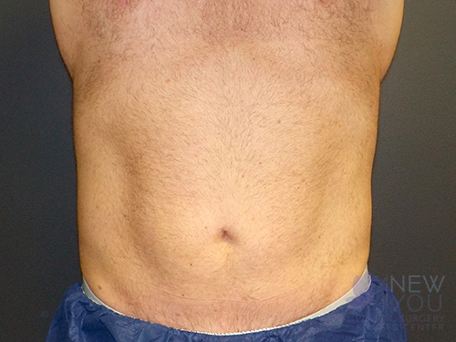 CoolSculpting® After CoolSculpting® After - Chicago, IL