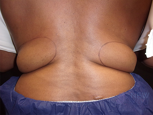 CoolSculpting® Before - Chicago, IL