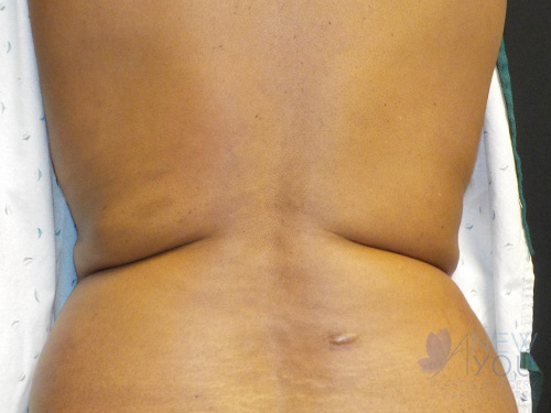 CoolSculpting® After - Chicago, IL