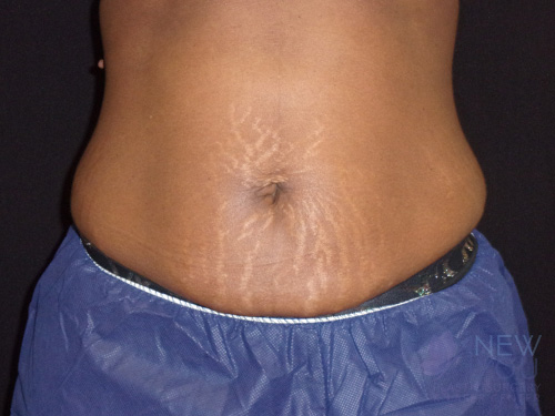 CoolSculpting® After - Chicago, IL