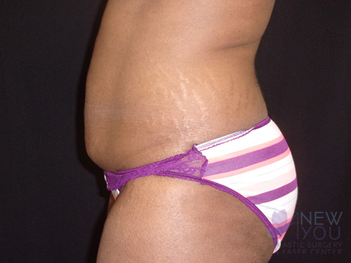 CoolSculpting® Before - Chicago, IL