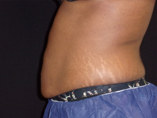 CoolSculpting® After - Chicago, IL