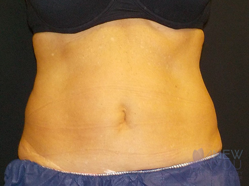 CoolSculpting® Before - Chicago, IL