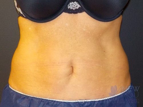 CoolSculpting® After - Chicago, IL