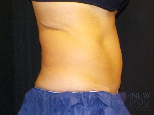 CoolSculpting® Before - Chicago, IL