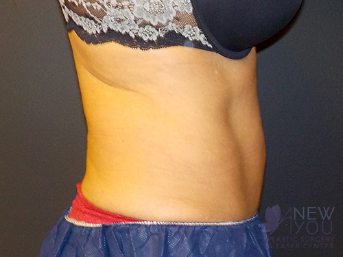 CoolSculpting® After - Chicago, IL