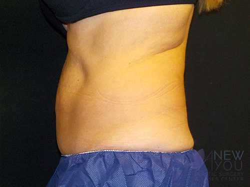 CoolSculpting® Before - Chicago, IL