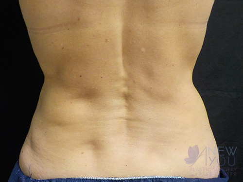 CoolSculpting® Before - Chicago, IL