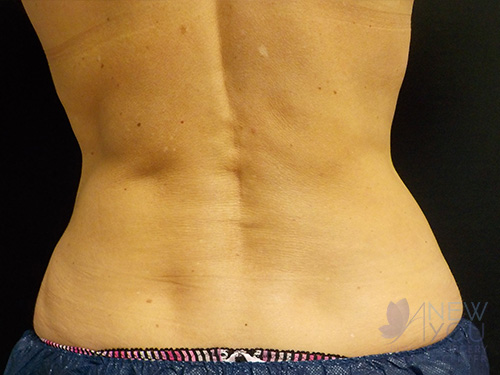 CoolSculpting® After CoolSculpting® After - Chicago, IL
