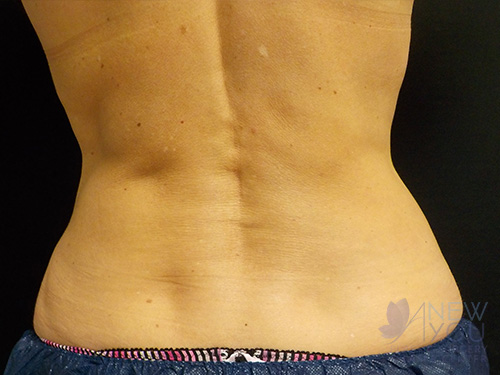 CoolSculpting® After - Chicago, IL