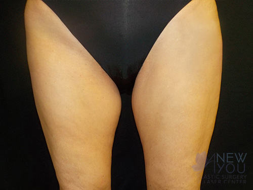 CoolSculpting® Before - Chicago, IL