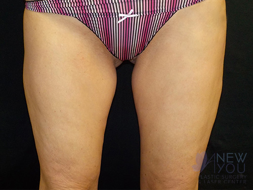 CoolSculpting® After - Chicago, IL