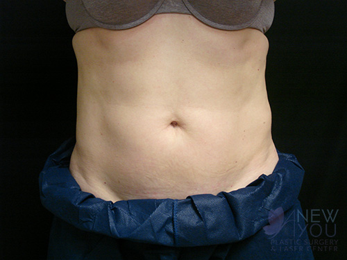 CoolSculpting® Before - Chicago, IL