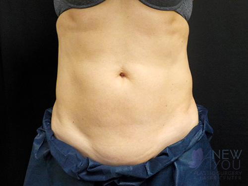 CoolSculpting® After - Chicago, IL