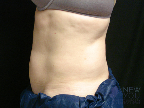 CoolSculpting® Before - Chicago, IL