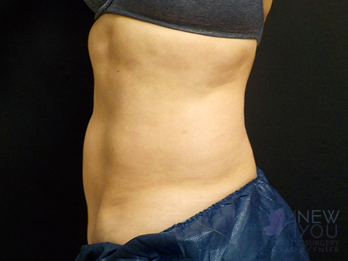 CoolSculpting® After - Chicago, IL