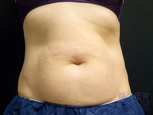 CoolSculpting® Before CoolSculpting® Before - Chicago, IL