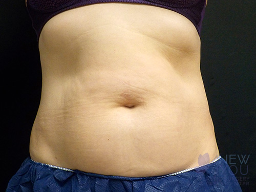 CoolSculpting® Before - Chicago, IL