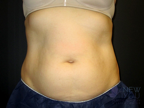 CoolSculpting® After - Chicago, IL