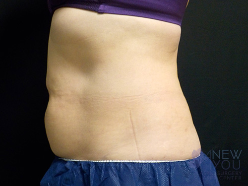 CoolSculpting® Before CoolSculpting® Before - Chicago, IL
