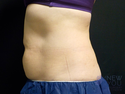 CoolSculpting® Before - Chicago, IL