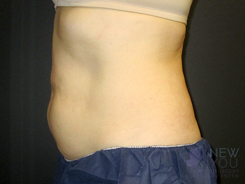 CoolSculpting® After - Chicago, IL