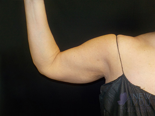 CoolSculpting® Before CoolSculpting® Before - Chicago, IL