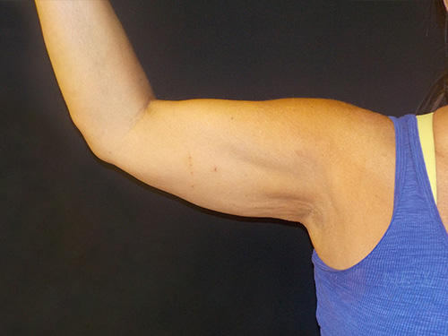 CoolSculpting® After CoolSculpting® After - Chicago, IL