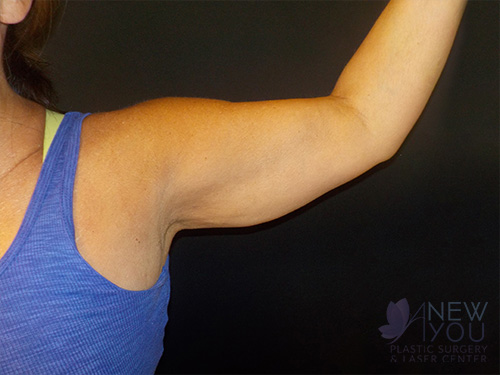 CoolSculpting® After CoolSculpting® After - Chicago, IL
