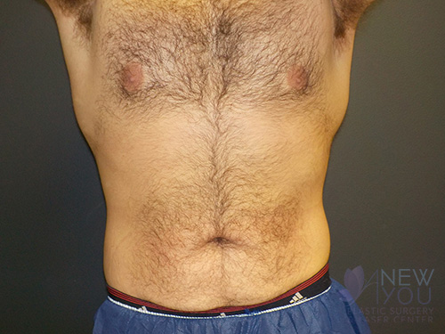 CoolSculpting® Before - Chicago, IL