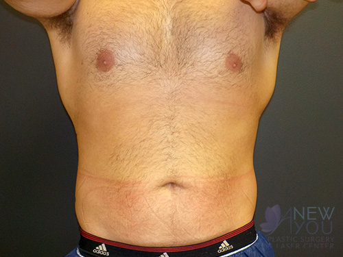 CoolSculpting® After - Chicago, IL