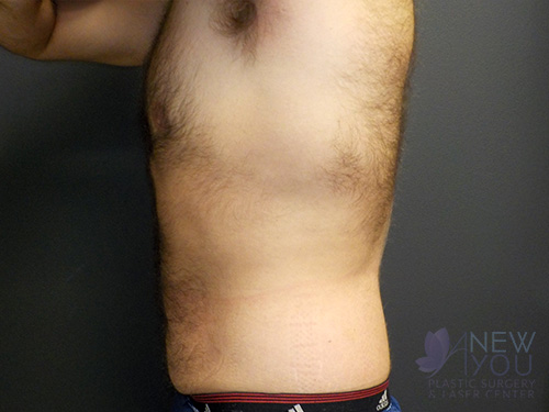 CoolSculpting® After CoolSculpting® After - Chicago, IL