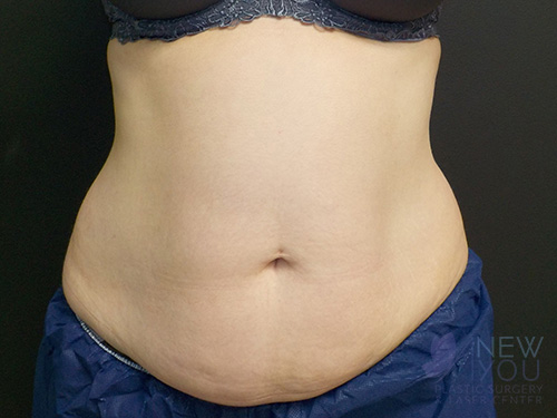 CoolSculpting® Before - Chicago, IL