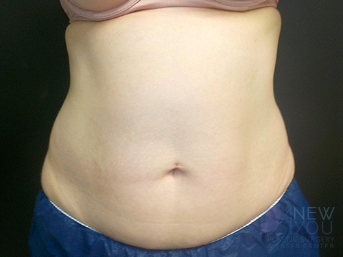 CoolSculpting® After - Chicago, IL