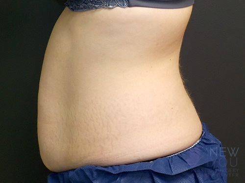 CoolSculpting® Before - Chicago, IL