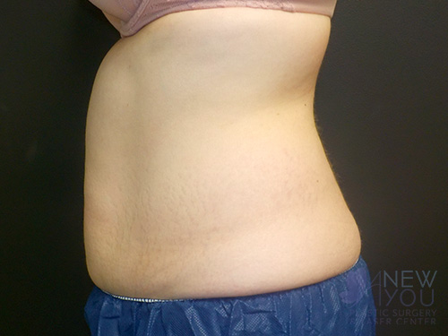 CoolSculpting® After - Chicago, IL