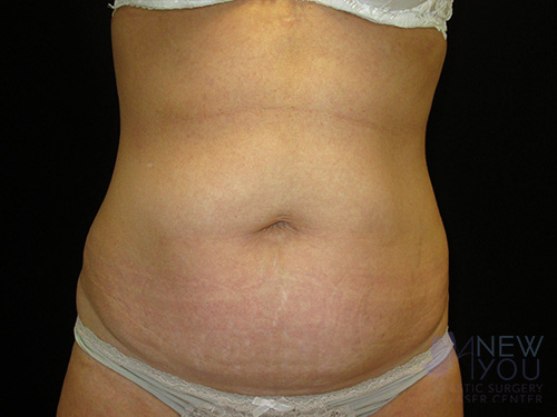 CoolSculpting® Before - Chicago, IL