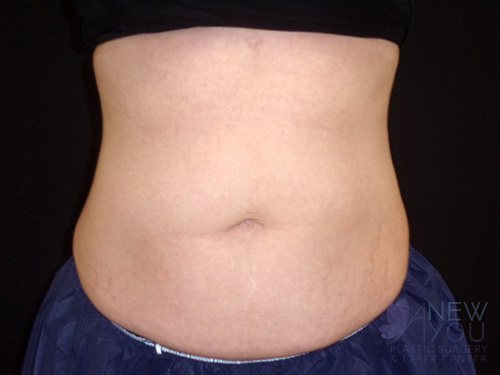 CoolSculpting® After - Chicago, IL