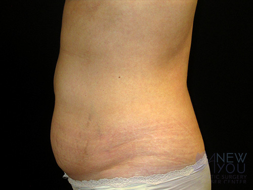 CoolSculpting® Before - Chicago, IL