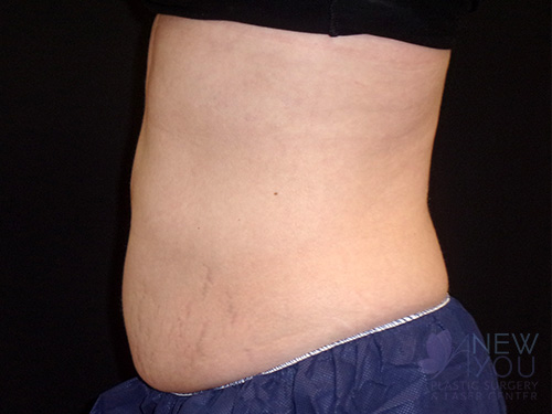 CoolSculpting® After - Chicago, IL