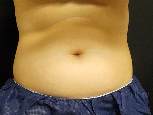 CoolSculpting® Before - Chicago, IL