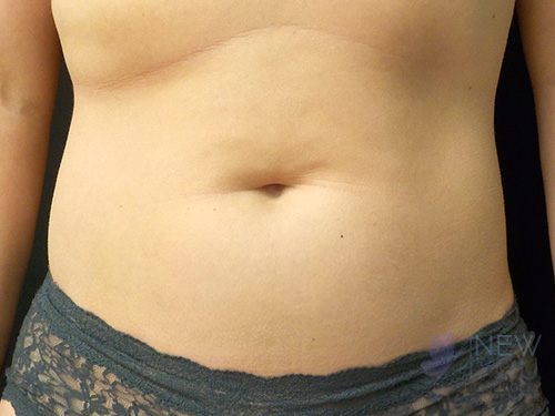 CoolSculpting® After - Chicago, IL