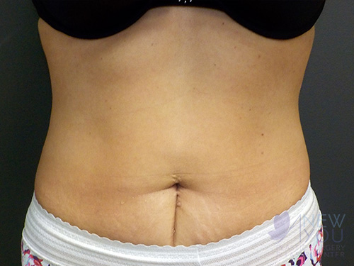 CoolSculpting® After - Chicago, IL