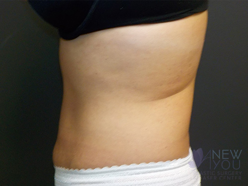 CoolSculpting® After - Chicago, IL