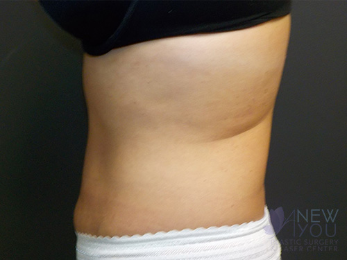 CoolSculpting® After CoolSculpting® After - Chicago, IL
